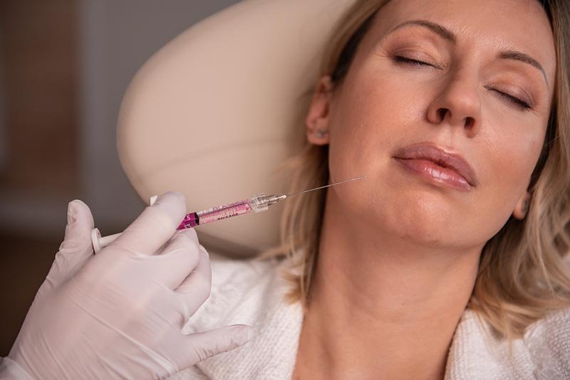 Behandeling mondhoekplooi/ marionetlijnen | Patrice Visser Kliniek