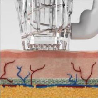 RF Microneedling - stap 1 van de behandeling