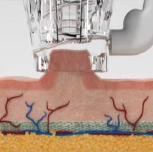RF Microneedling - stap 2 van de behandeling