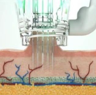 RF Microneedling - stap 3 van de behandeling