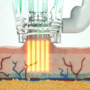 RF Microneedling - stap 4 van de behandeling