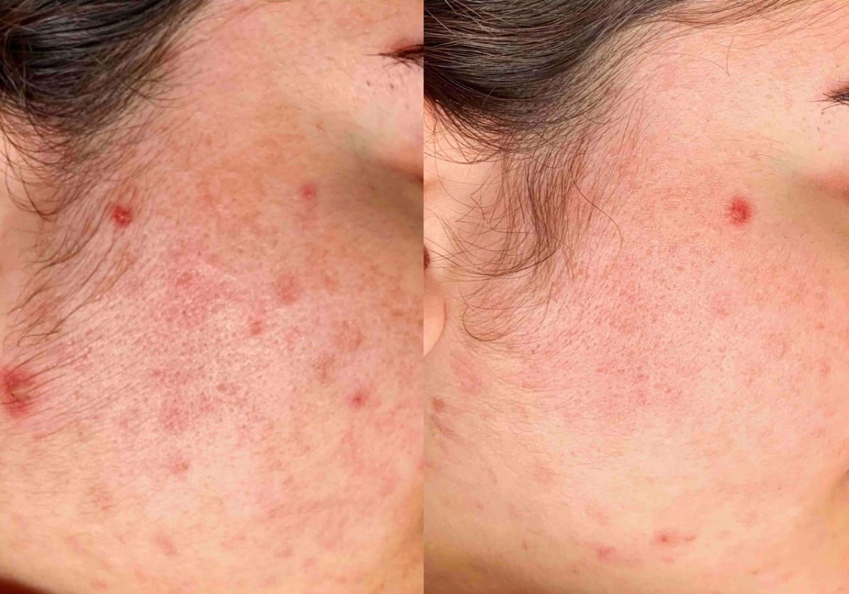skinpen acne