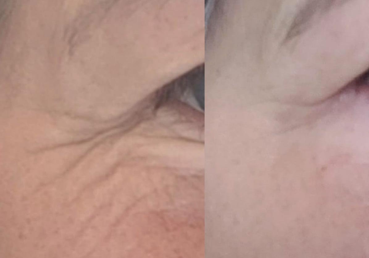 skinpen fijne lijntjes