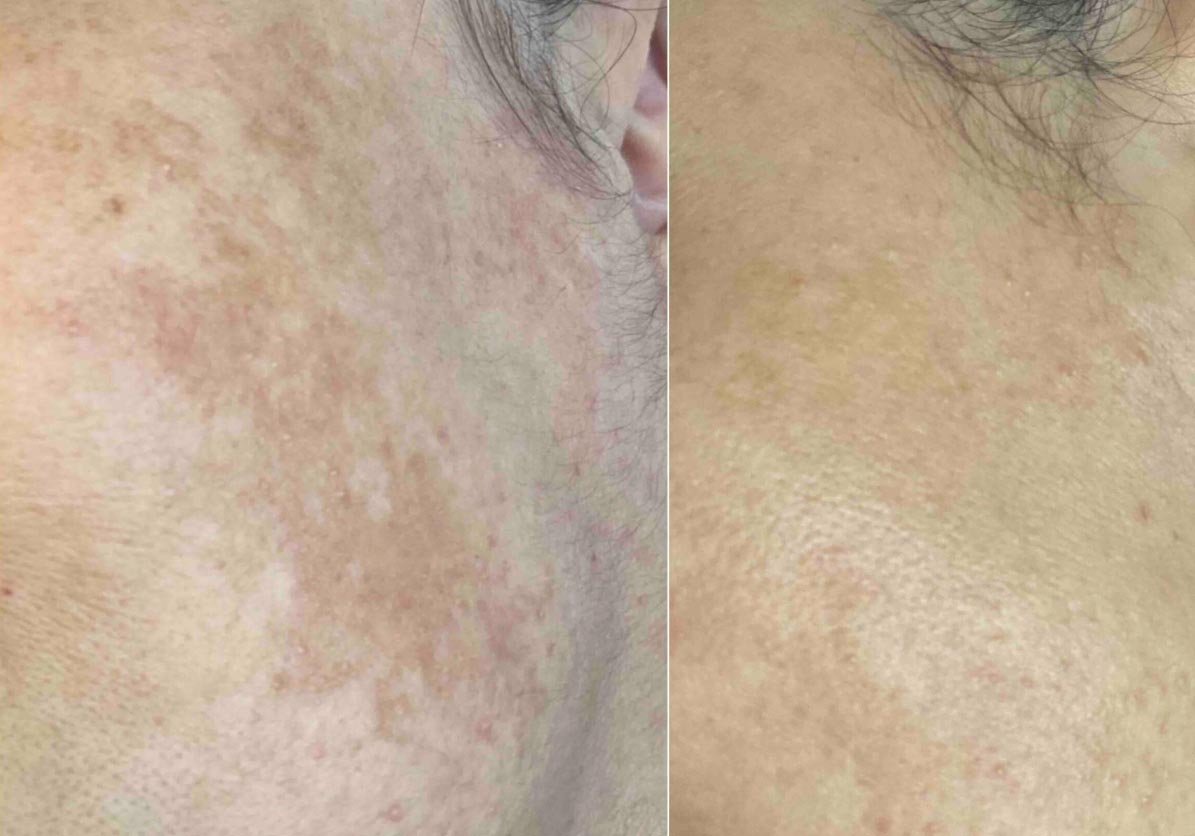 skinpen Pigmentvlekken