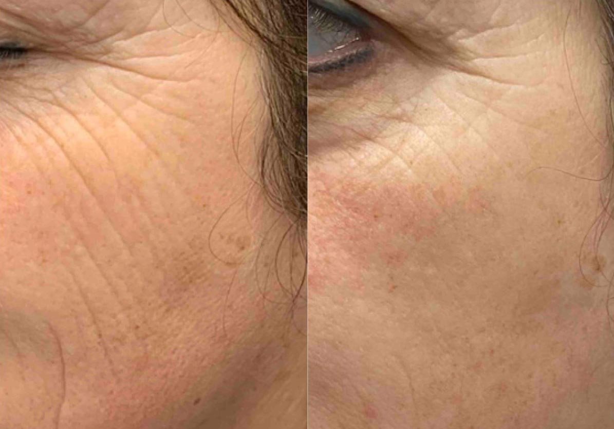 skinpen fijne lijntjes