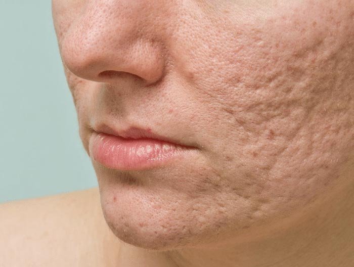 Behandel indicatie acne littekens