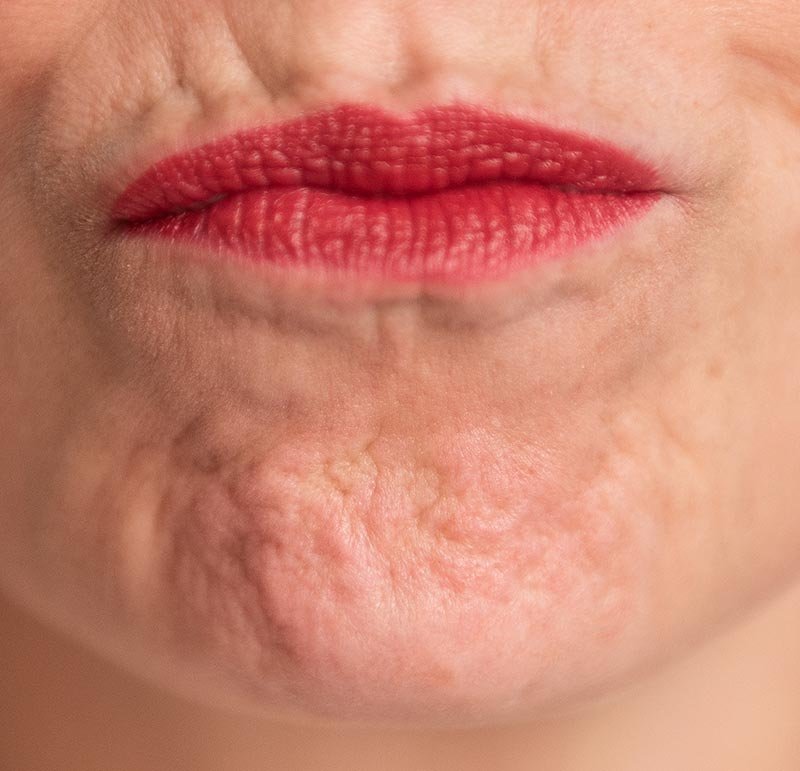 Kinrimpels indicatie