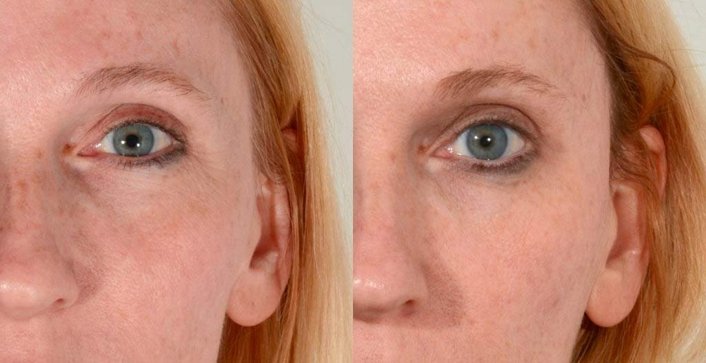 Voor na foto behandeling volumeverlies slapen | PAtrice Visser Kliniek