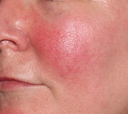 Couperose indicatie | IPL Laser behandeling Patrice Visser Kliniek